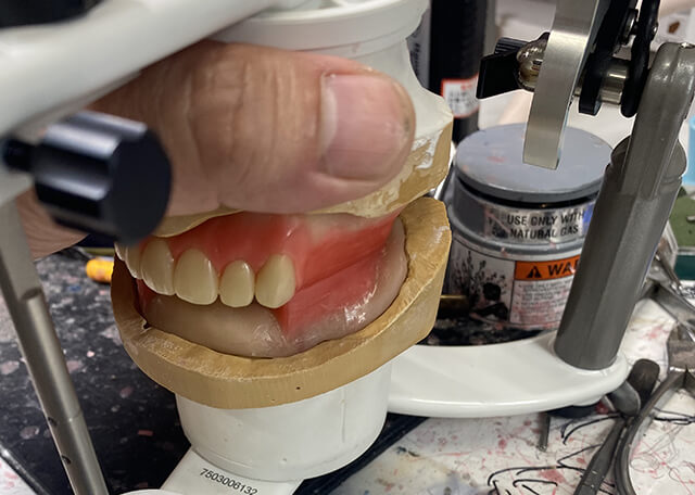 Complete Denture