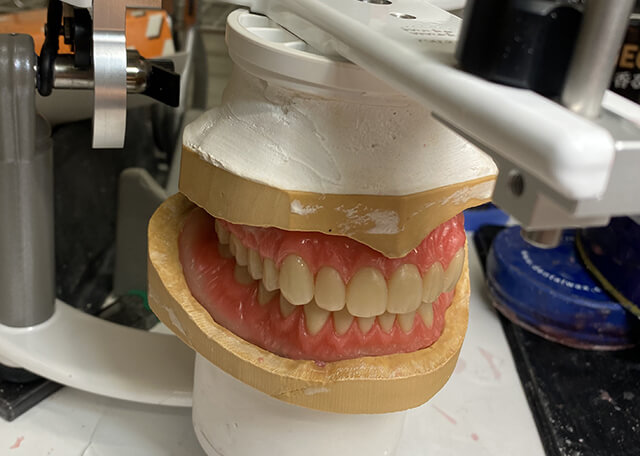 Complete Denture