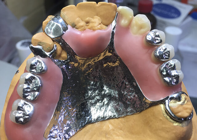 人工歯置換 e-max