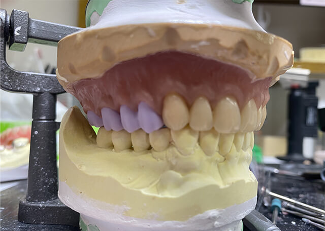 人工歯置換 e-max