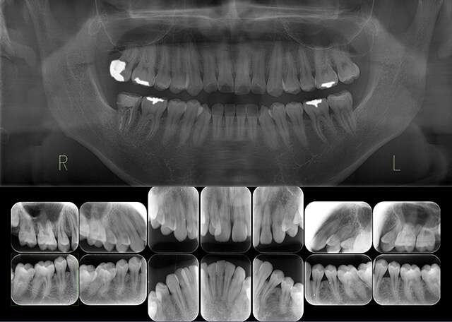 レントゲン写真（歯根の平行性などの評価）