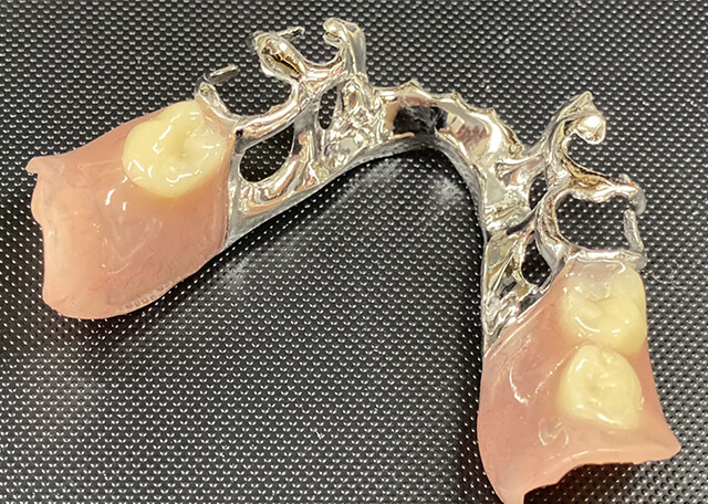 金属床（メタルプレート）義歯