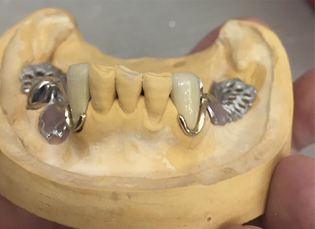 金属床（メタルプレート）義歯